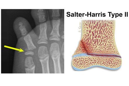 5th toe fracture - Salter-Harris type II | Radiology Case | Radiopaedia.org | Epiphyseal plate ...