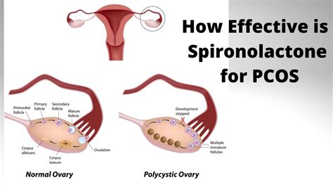 How Effective is Spironolactone for PCOS - YouTube