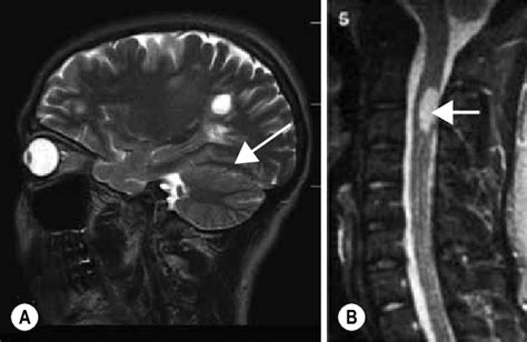 Cervical Spinal Cord Lesion MRI