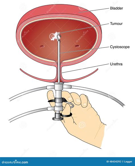 Cystoscopy Of Bladder Stock Vector - Image: 48434292