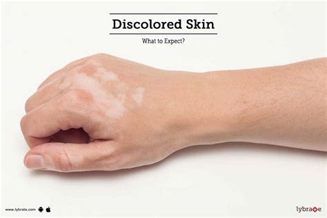 Discolored Skin - What to Expect? - By Dr. Anand Bhatia | Lybrate