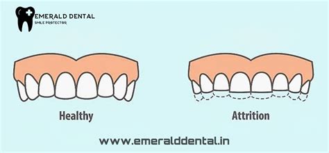 DENTAL ATTRITION? - EMERALD DENTAL