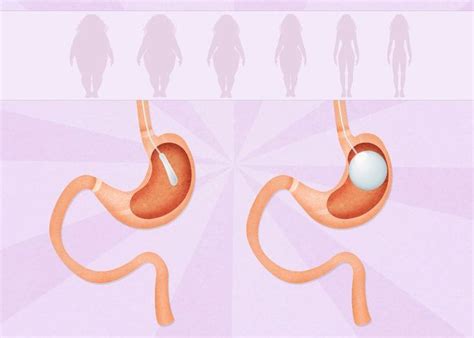 An Introductory Guide to Gastric Balloon Surgery | Balloons, Surgery ...