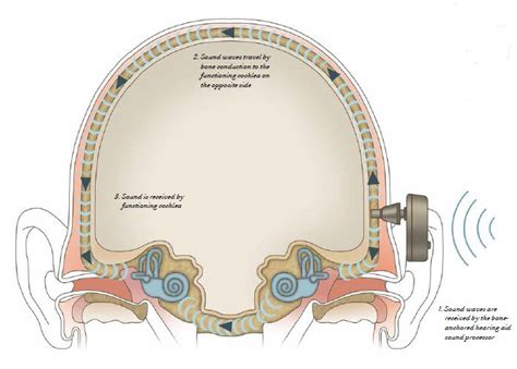 Hearing Aid Diagram