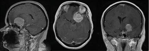 Surgery of Meningiomas of the Anterior Clinoid Process | IntechOpen