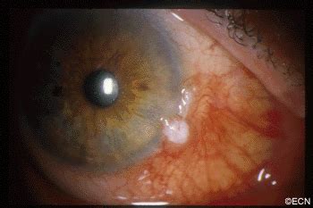Squamous Carcinoma and Intraepithelial Neoplasia of the Conjunctiva » New York Eye Cancer Center