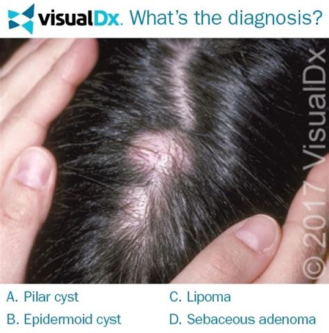 Sebaceous Cyst Vs Lipoma - Infoupdate.org