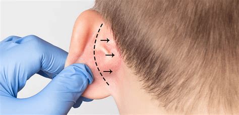 Otoplasty Surgery