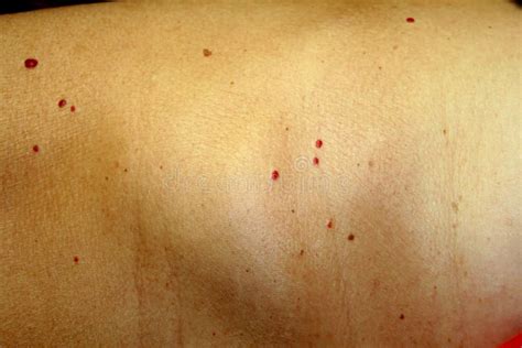 Angioma on the Skin. Red Moles on the Body. Many Birthmarks. Stock Image - Image of disease ...