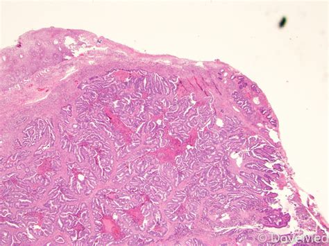 Adenocarcinoma of Cervix