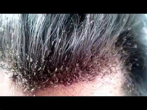 Cara Menghilangkan Kutu Rambut Dan Telurnya Dengan Cepat 1 Hari - YouTube