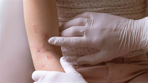 11 Common Rashes on Kids and Preschoolers (With Images) - GoodRx