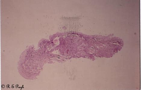 Dirofilaria immitis (pathology) 12 18.jpg