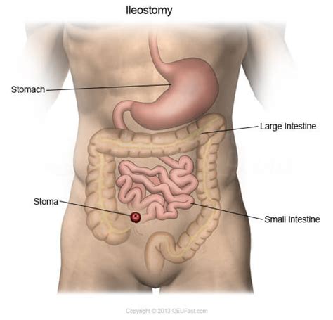 Ostoma-Tology: Colostomy, Ileostomy, Urostomy | Nursing CEU | CEUfast