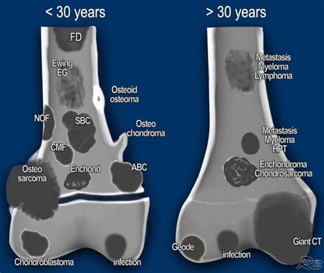 The Radiology Assistant : Bone tumors - Differential diagnosis