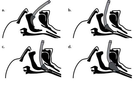 Tricks For LMA Insertion - The Airway Jedi, technique, potential problems