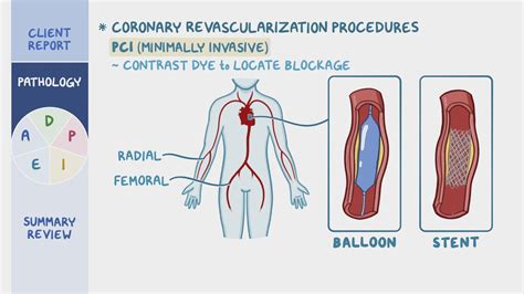 Coronary artery disease (CAD) and angina pectoris: Nursing process (ADPIE) - Osmosis Video Library