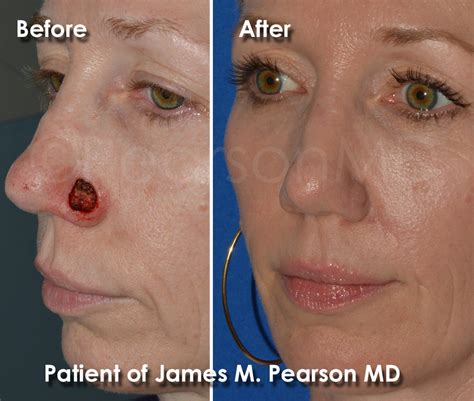 Photo Gallery Reconstructive - Dr. James Pearson Facial Plastic Surgery