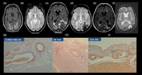 The diagnosis and overdiagnosis of cerebral vasculitis | Neupsy Key