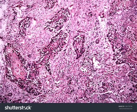 Central Lung Cancer Human Photomicrograph Panorama Stock Photo 128179730 - Shutterstock