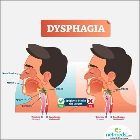 Treatment of dysphagia - MEDizzy