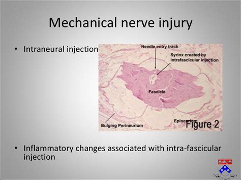 Complications of Regional Anesthesia