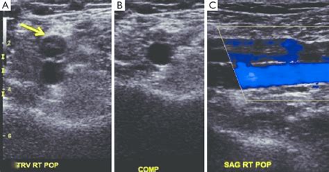 Blood Clot In Leg Ultrasound