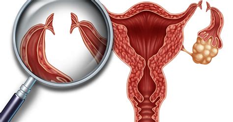 Tubal Ligation Reversal: Purpose, Preparation, Procedure, Recovery, Results & Risks