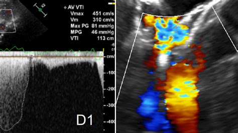 Complications of mitral valve interventions