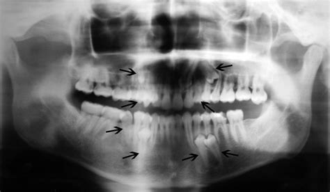 OPG of patient showing total 8 supernumerary teeth resembling premolars... | Download Scientific ...