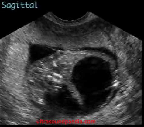 Prune belly syndrome – ULTRASOUNDPAEDIA