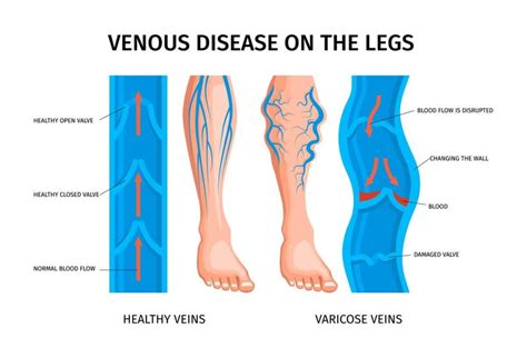 Venous Disease