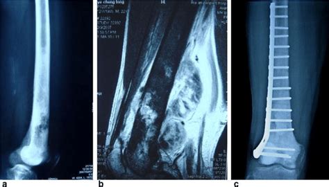 A patient with osteosarcoma involving nearly 3/4 length of the femur ...