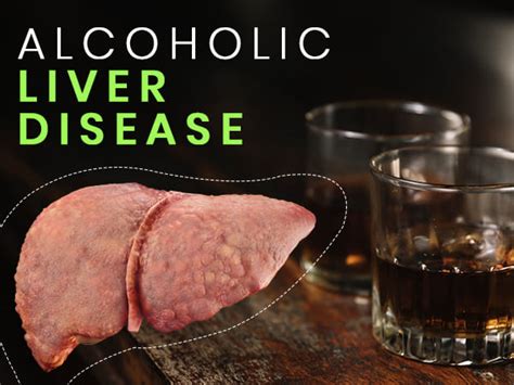 Alcoholic Liver Disease: Causes, Stages, Symptoms, Risk Factors, Diagnosis And Treatment ...