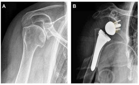 The Evolution of Reverse Total Shoulder Arthroplasty—From the First Steps to Novel Implant ...