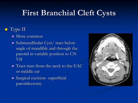 Branchial Cleft Cyst Causes Types Signs Symptoms Diag - vrogue.co