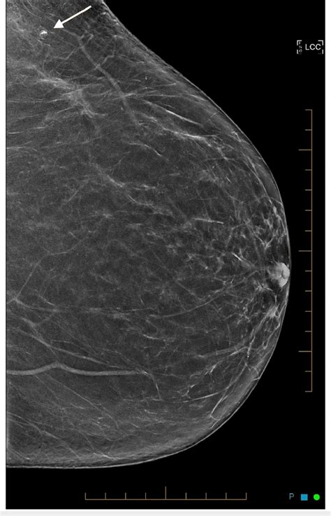 Left craniocaudal mammogram showing a small mass lesion containing ...