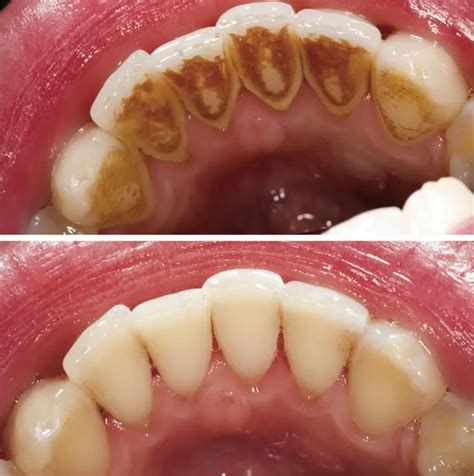 When is teeth scaling considered urgent?