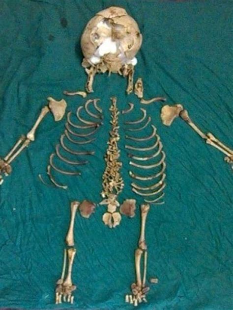 36-year-old skeleton of dead baby found inside Indian woman | The ...