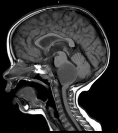 Locked in Syndrome: Actual Case, Symptoms, Causes & Diagnosis