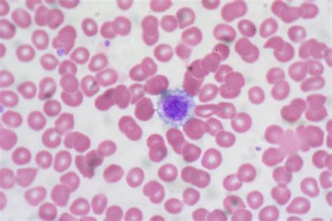 Giant Platelet, Peripheral Blood Smear | Ed Uthman | Flickr