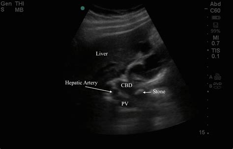 MEDICAL ULTRASOUND/STONE IN COMMON BILE DUCT