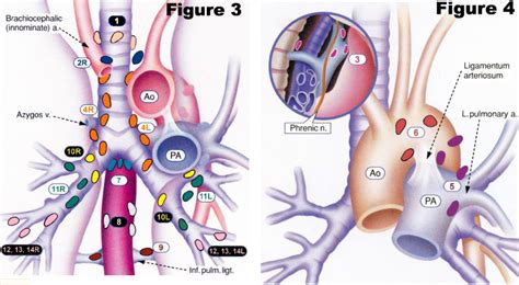 Lung Cancer Lymph Nodes