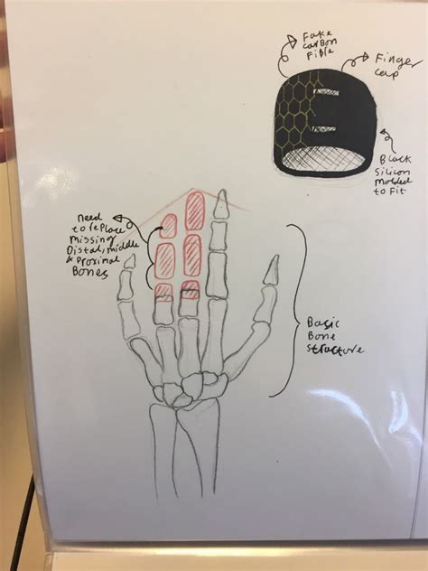 Multiple design options for working medical prosthetic fingers for client following loss of ...