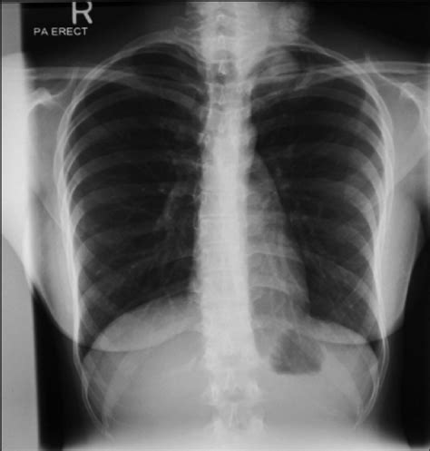 Chest X-ray, posterior-anterior (PA) view during first visit. | Download Scientific Diagram