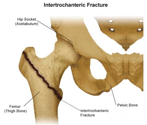 Types of Hip Fractures | Stanford Health Care