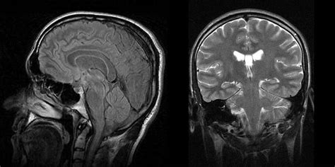 Narcolepsy Brain Damage