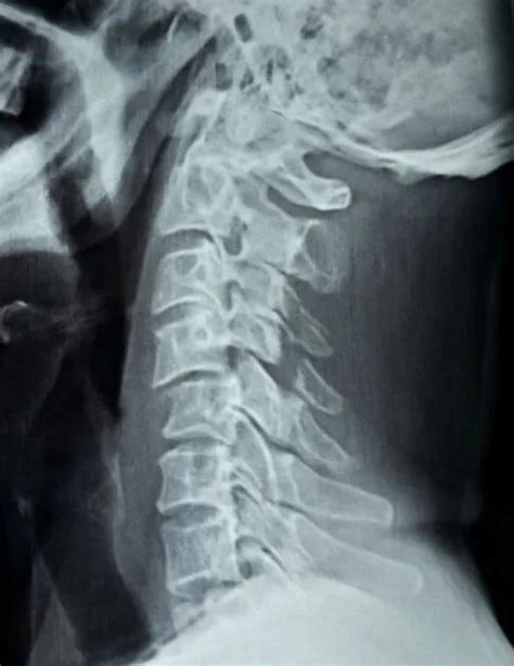 Cervical Injury Xrays | Bone and Spine