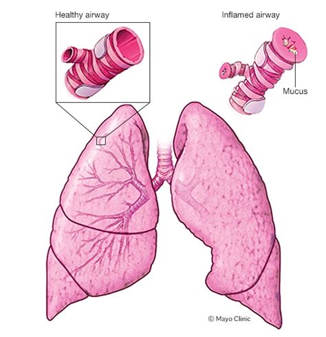 Asthma - Symptoms and causes - Mayo Clinic