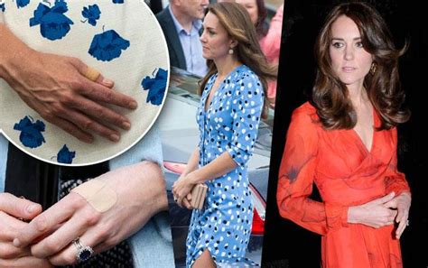 Kate Middleton Bulimia Rumors -- Princess Sparks Concern Over Photos